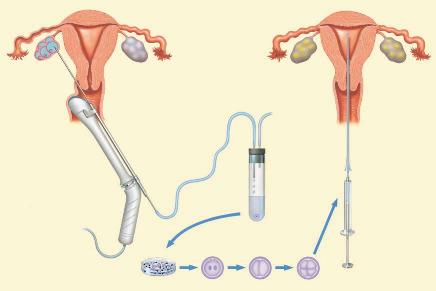 IVF